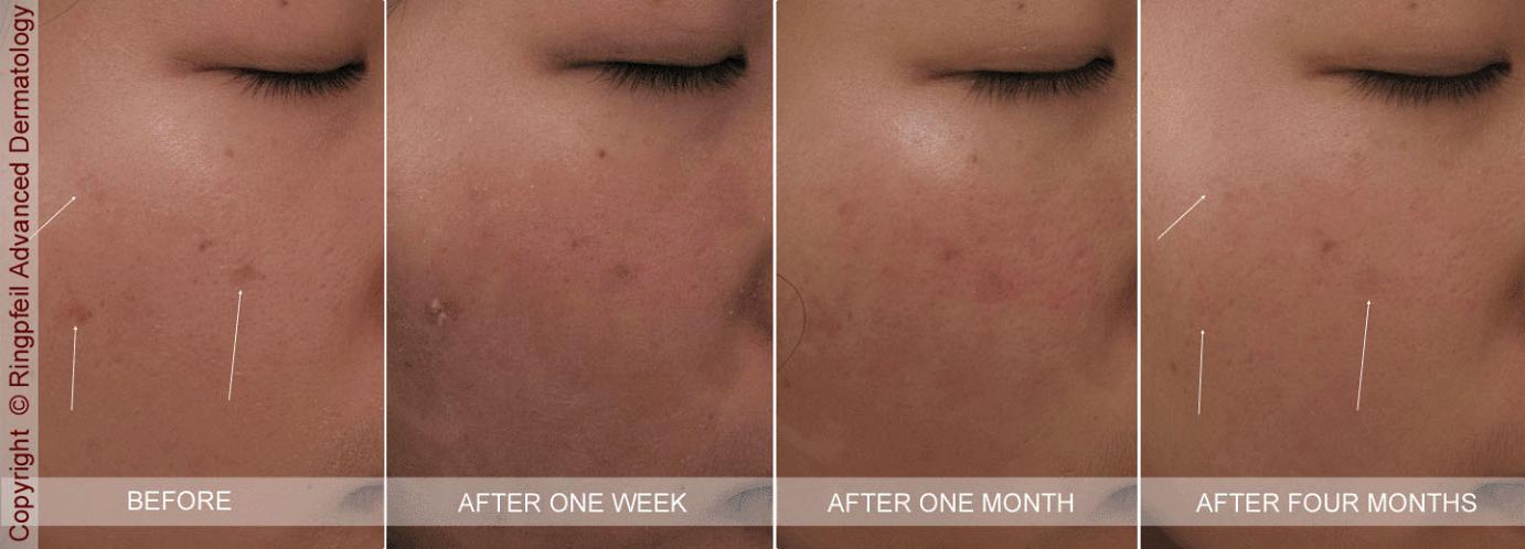 Acne Scars Before & After Photos New Jersey