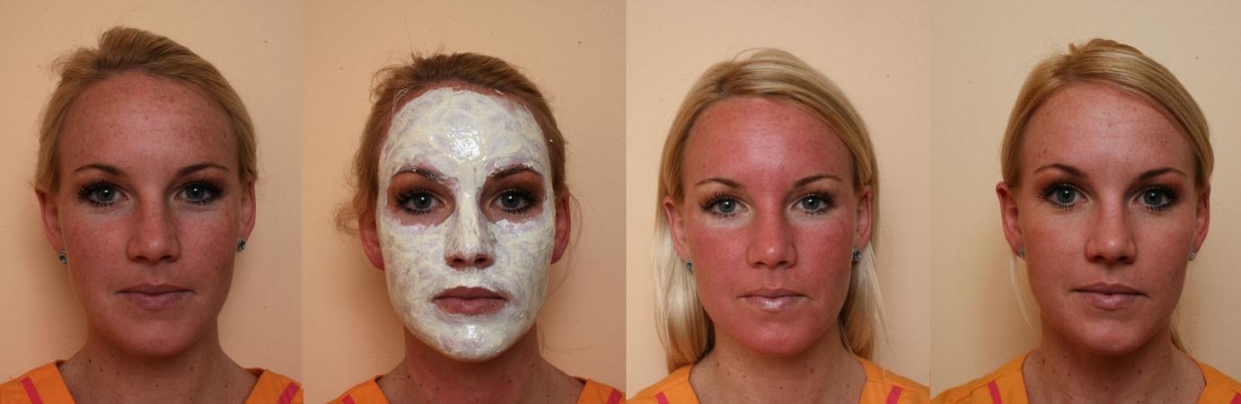 Brown Spots and Freckles  Faciem Dermatology Clinic