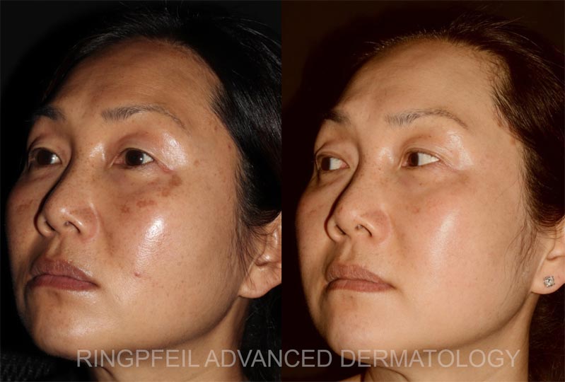 photos patient before and after treatments brown spots