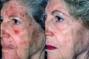 chemical peel before and after