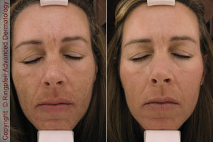 chemical peels before and after