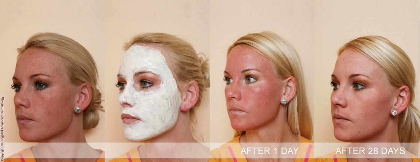 chemical peel treatment in Philadelphia