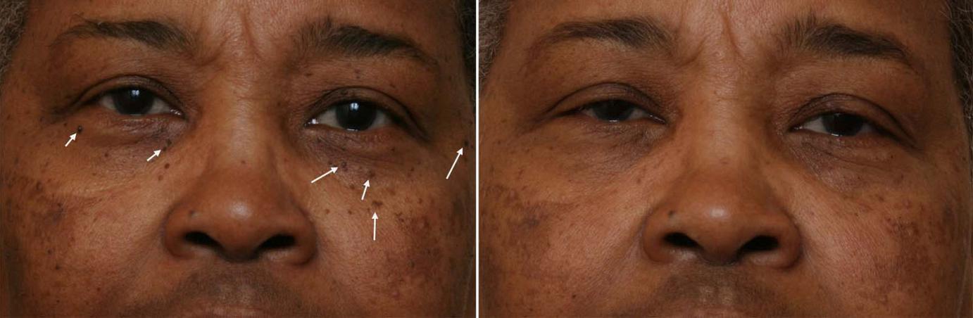 HydraFacial Before and After Photos & Treatment Overview African American and Ethnic Skin Dermatology - Black ...