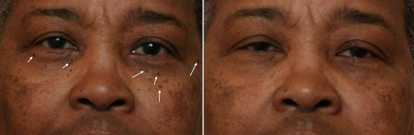 African American and Ethnic Skin Dermatology - Black 