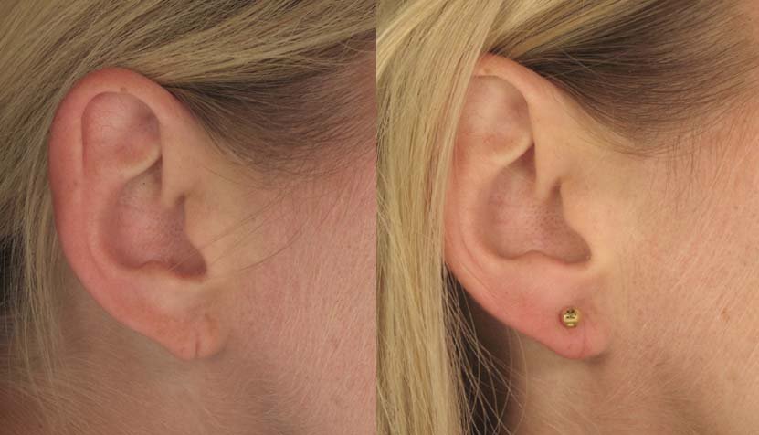 Earlobe Repair Dermatologist Philadelphia Dermatology Practice Main