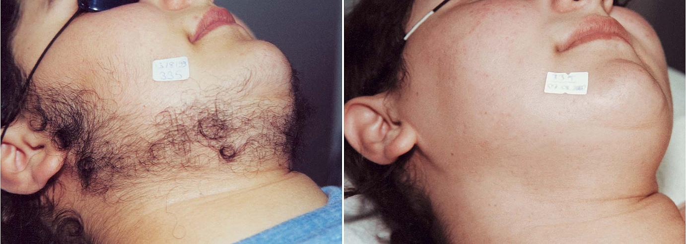 Before and after picture of facial laser hair removal