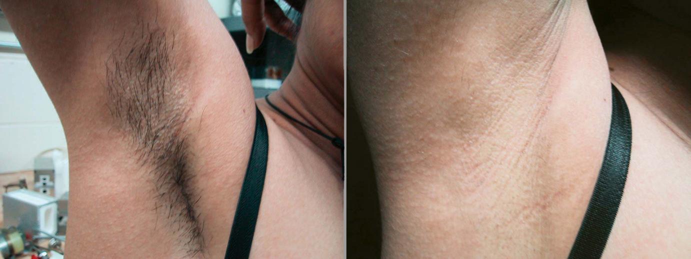 removing women underarm hair with laser in Philadelphia