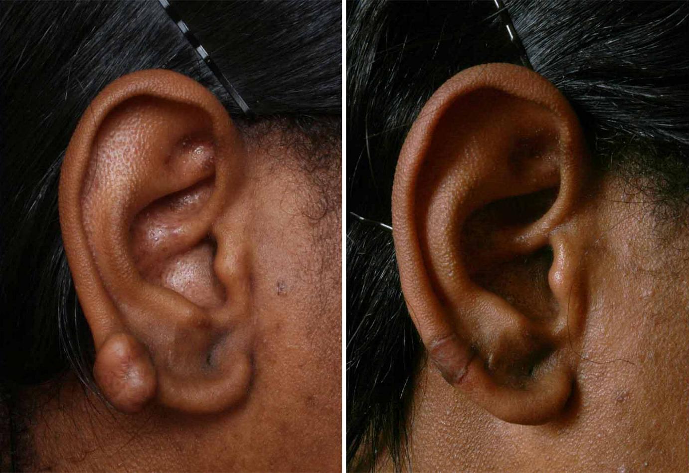 Earlobes repair Philadelphia, PA Torn Ear Lobe Main Line