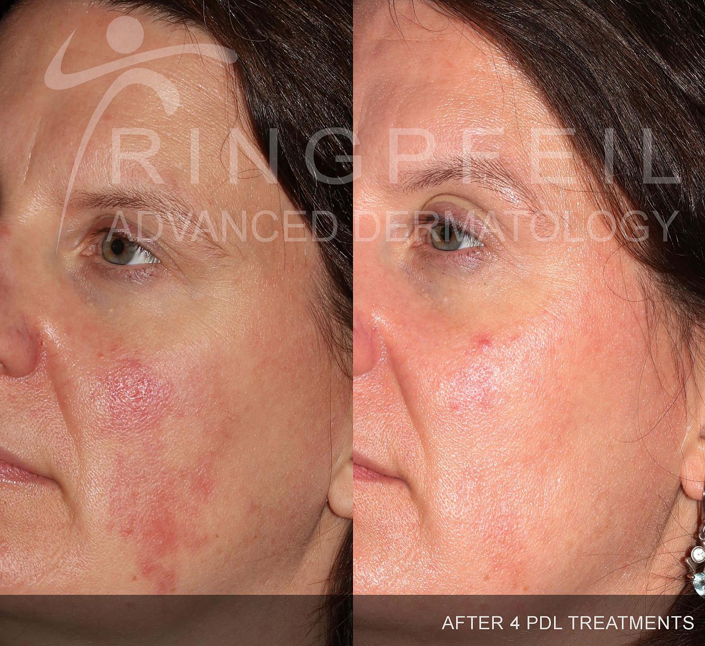 rosacea treatment before and after 2