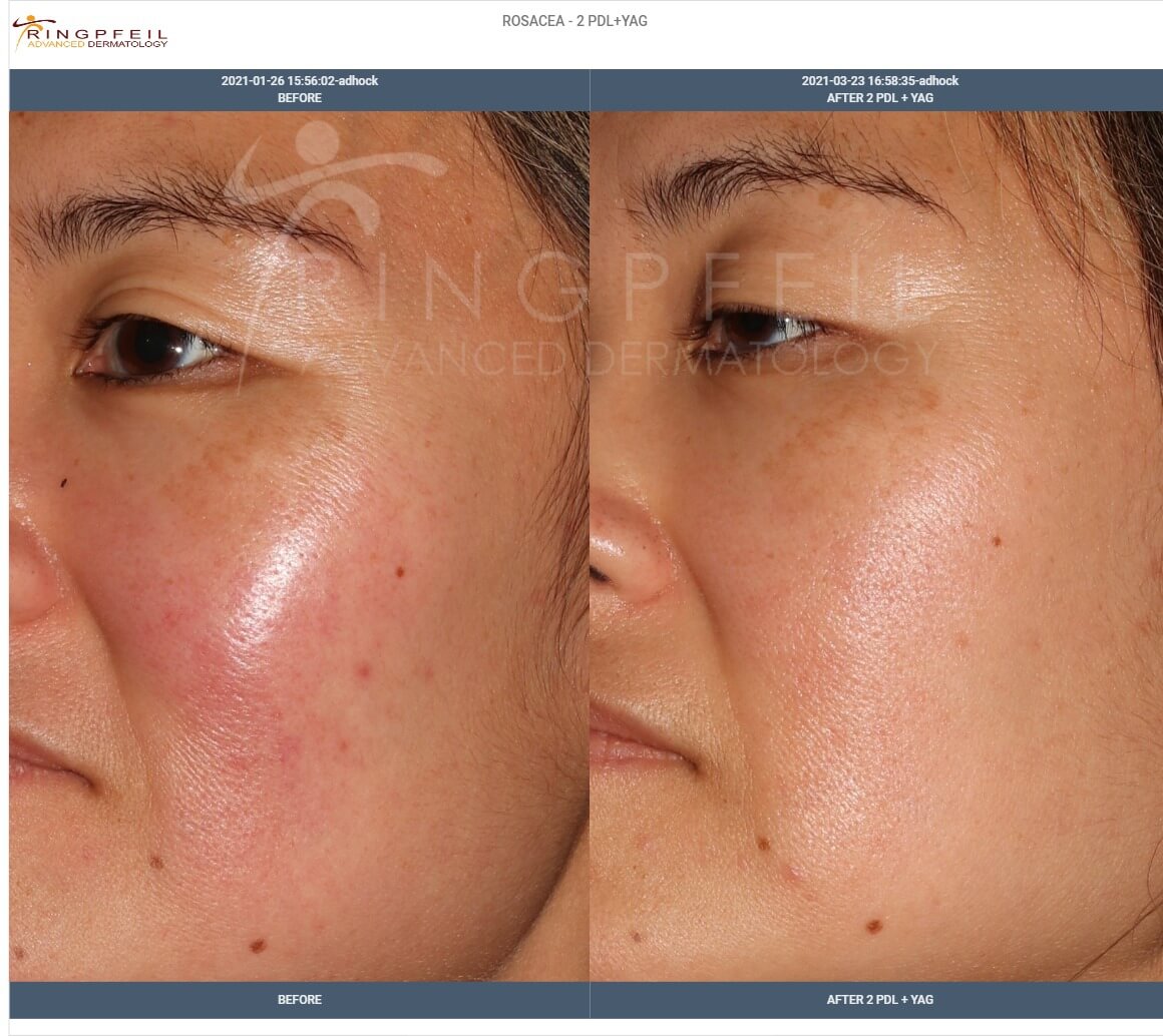 rosacea treatment before and after 2