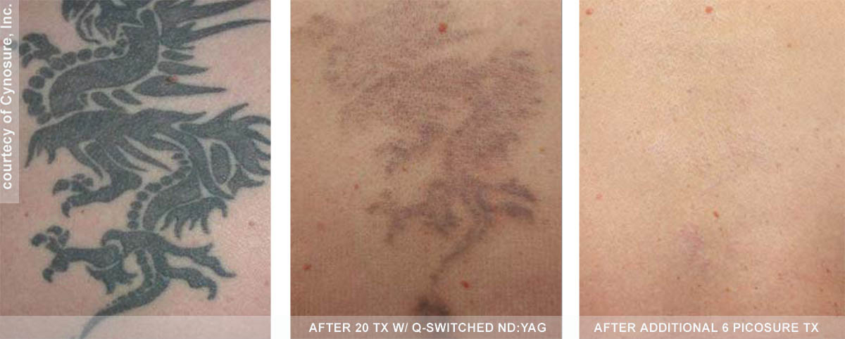 PicoSure® tattoo removal treatment before and after