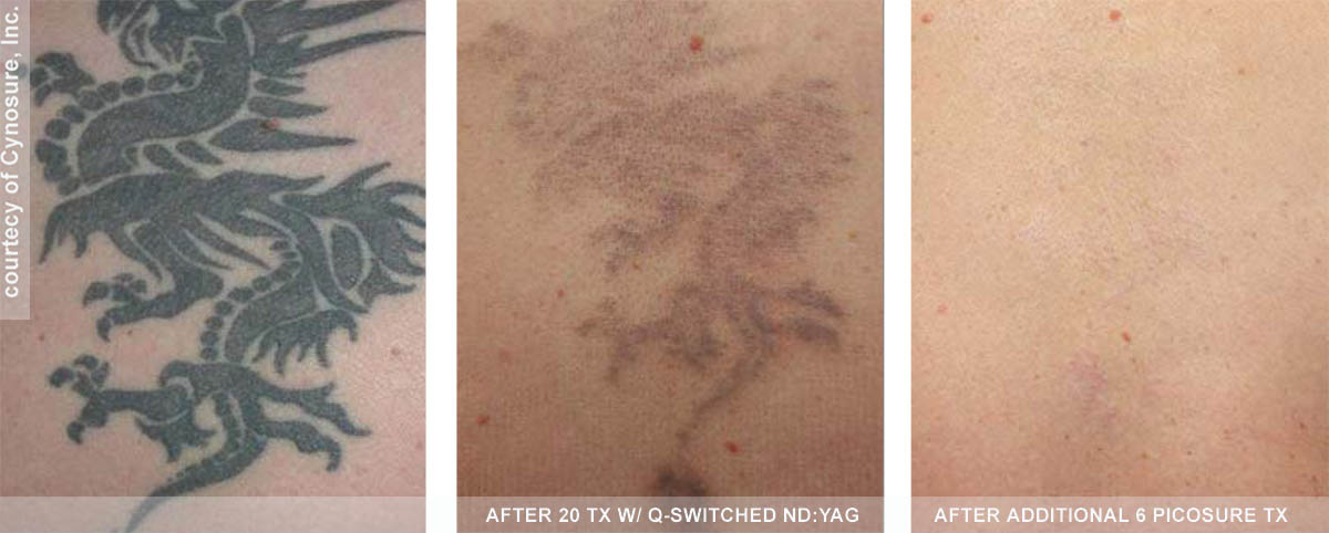 Picosure Laser Tattoo Removal