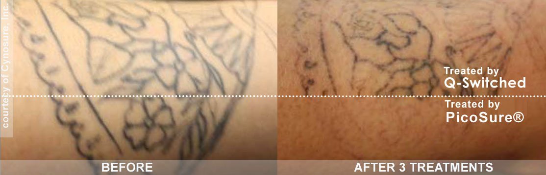 Before and After 3 Treatment -Picosure Vs. QSwitch in Philadelphia - tattoo removal