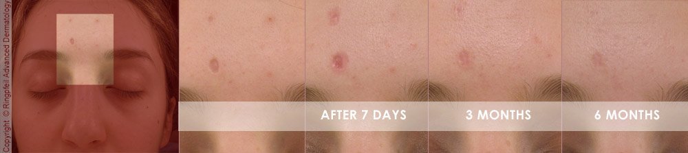 acne scar treatment before and after