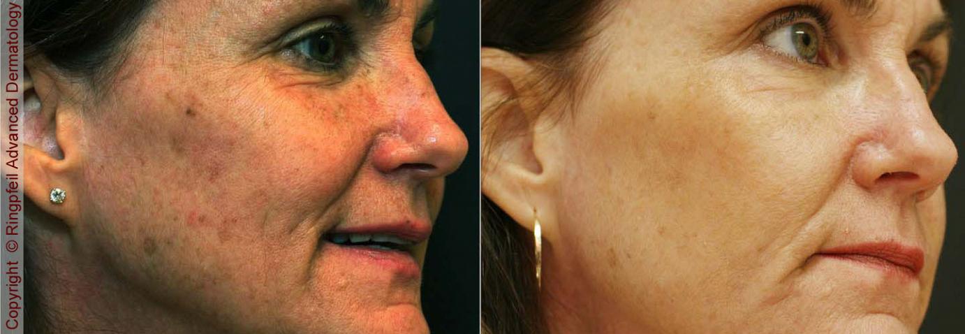 skin rejuvenation before and after