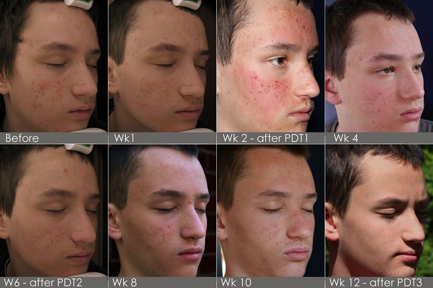 Teenage Acne Treatment in Philadelphia and Mainline PA ...