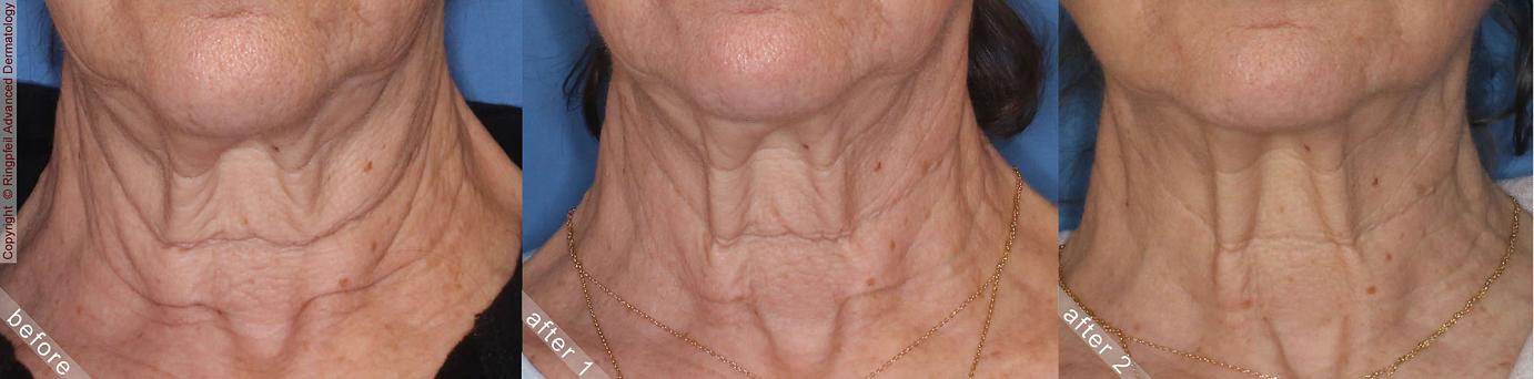 Neck Lifts before and after