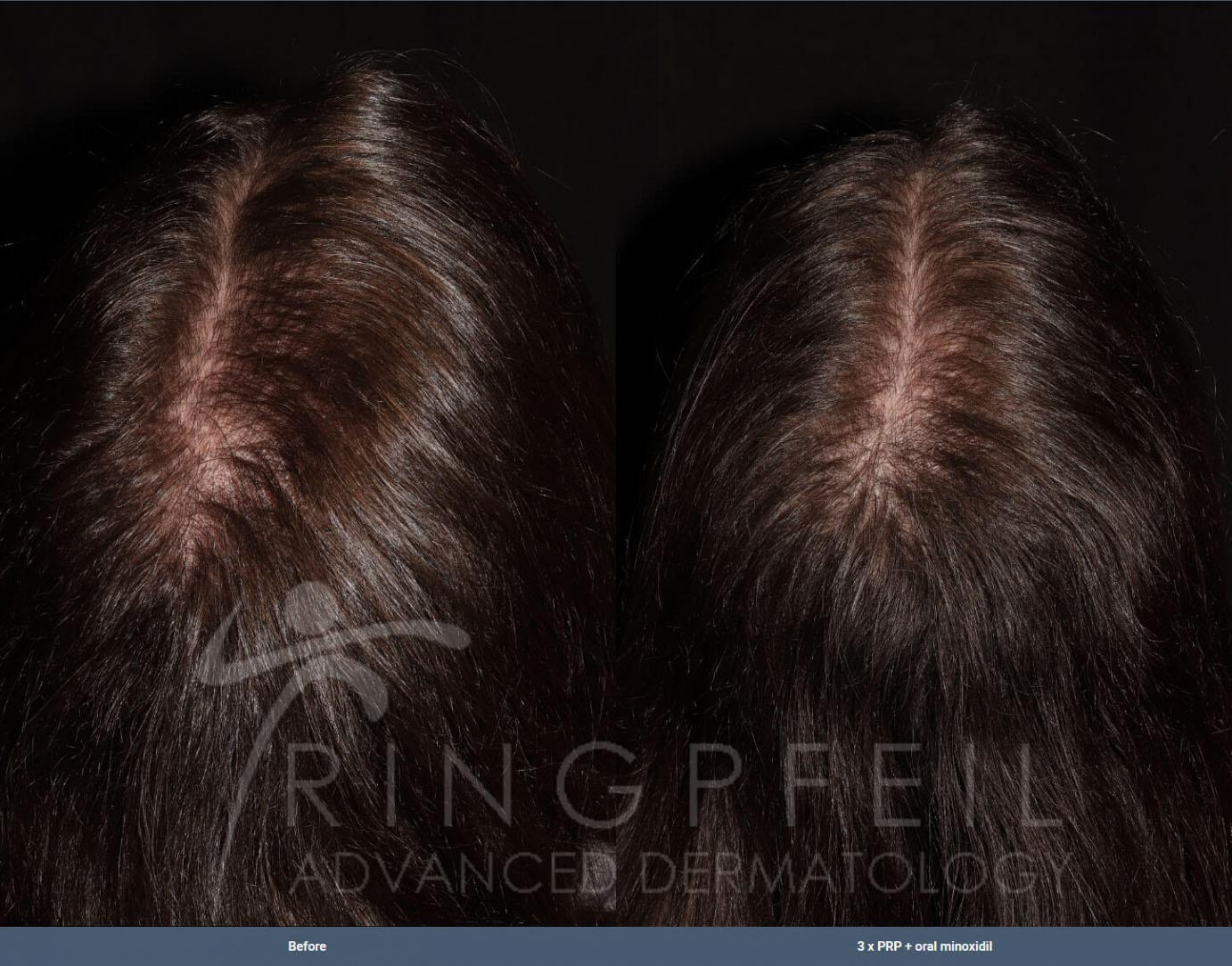 PRP after two treatments